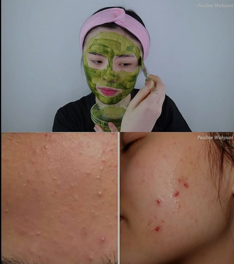 Jarang Ada yang Tahu Kandungan Masker Greentea dan Madu Mampu Hilangkan Jerawat dan Bruntusan Pada Wajah 1 Jarang Ada yang Tahu Kandungan Masker Greentea dan Madu Mampu Hilangkan Jerawat dan Bruntusan Pada Wajah