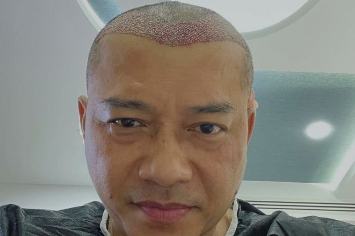 Tidak Akan Botak Seumur Hidup, Anang Hermansyah Transplantasi Rambut Saat Berlibur di Turki 9 Tidak Akan Botak Seumur Hidup, Anang Hermansyah Transplantasi Rambut Saat Berlibur di Turki