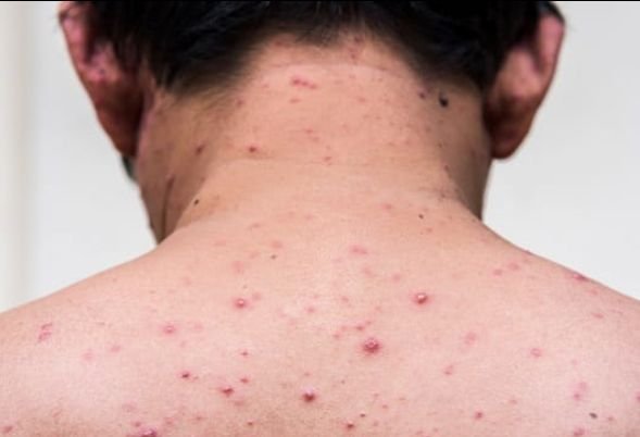 Apa itu Virus Cacar Monyet Langka dan Bagaimana Penyebarannya? 1 Apa itu Virus Cacar Monyet Langka dan Bagaimana Penyebarannya?