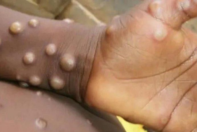 Kasus Cacar Monyet Terus Bermunculan, di Belgia Diduga Menyebar dari Festival Gay