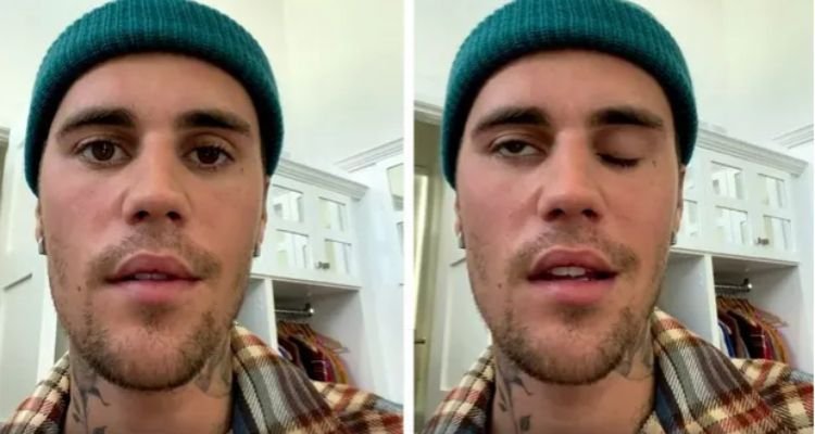 Wajah Justin Bieber Bisa Lumpuh Permanen Akibat Sindrom Ramsay Hunt! 1 Wajah Justin Bieber Bisa Lumpuh Permanen Akibat Sindrom Ramsay Hunt!