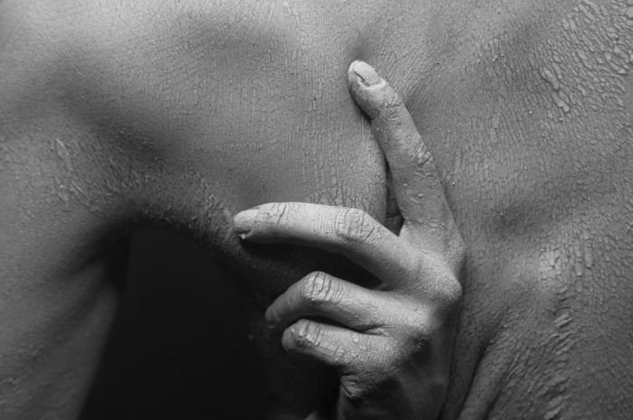 Lansia di Pulomerak Kota Cilegon Diduga Suspek Cacar Monyet, Dinkes Minta Warga Tak Resah