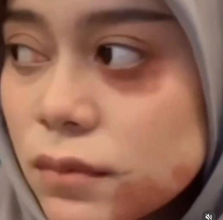 Aty Kodong bagikan foto wajah Lesti Kejora yang tampak memar: merinding lihat ini! 1 Aty Kodong bagikan foto wajah Lesti Kejora yang tampak memar: merinding lihat ini!