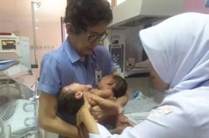 Bukan Cuma 1, Ternyata Ada 2 Kasus Kembar Siam di Kabupaten Lebak