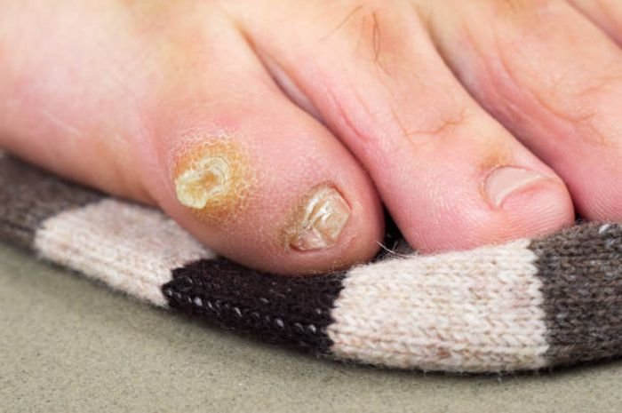 Terkena Mata Ikan dan Bingung Mengatasinya? Cek Penyebab dan Caranya